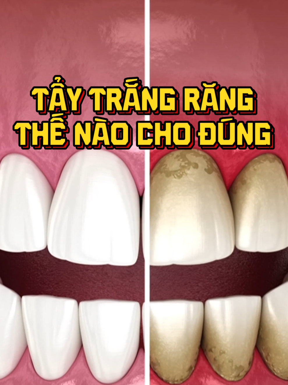 Bí ẩn tẩy trắng răng làm hỏng răng #viral #LearnOnTikTok #nhakhoa #bian #dental