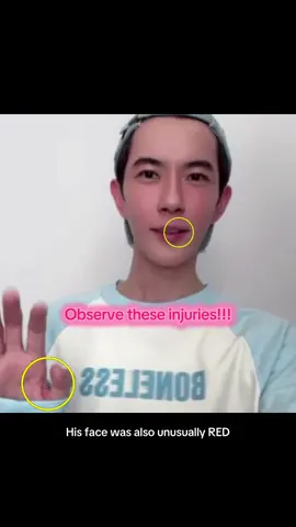 🐟 Yu Menglong suffered INJURIES and was suspected to be KNEELING throughout the 1-hour long live stream! 🐟 🔎 SUSPICIOUS POINTS 1) He movements showed that he was likely to be kneeling!!! That must be so torturous and painful 😭 2) Injuries were spotted on his hand and lip when he waved goodbye at the end of the session. He slowed the waving which showed the injury, then closed his palm quickly after. It seemed to be intentional! 3) Unlike his usual self, he appeared to be really distracted and only spoke when he was called upon by the MC. Even the audience pointed out that he’s extremely quiet! 4) His face grew redder with time. He said it’s due to the heat, but could it be from the kneeling as well? 5) He kept looking down and diagonally upwards, showing that he was at a lower position, and people were monitoring him. He seemed really conscious and uncomfortable. Culprits logged onto his social media (Weibo) & changed the setting to show post 6 months prior only. This means that all his posts will eventually not be visible anymore 😭 I continue to dig for clues and share them here, we must seek justice for this beautiful soul! Please sign the petition if you haven’t, beware of the fake petitions pages! Do not hesitate to share any clues below / if you want me to dig further into a specific thing!!! #于朦胧 #yumenglong #chinadrama #china #justiceforyumenglong 