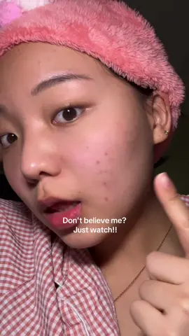 Don't believe me? Just watch!👀 My holy grail cream🤍@Dr.Althea US #dralthea345cream #koreanskincare #glassskin #acnetreatment #dralthea 