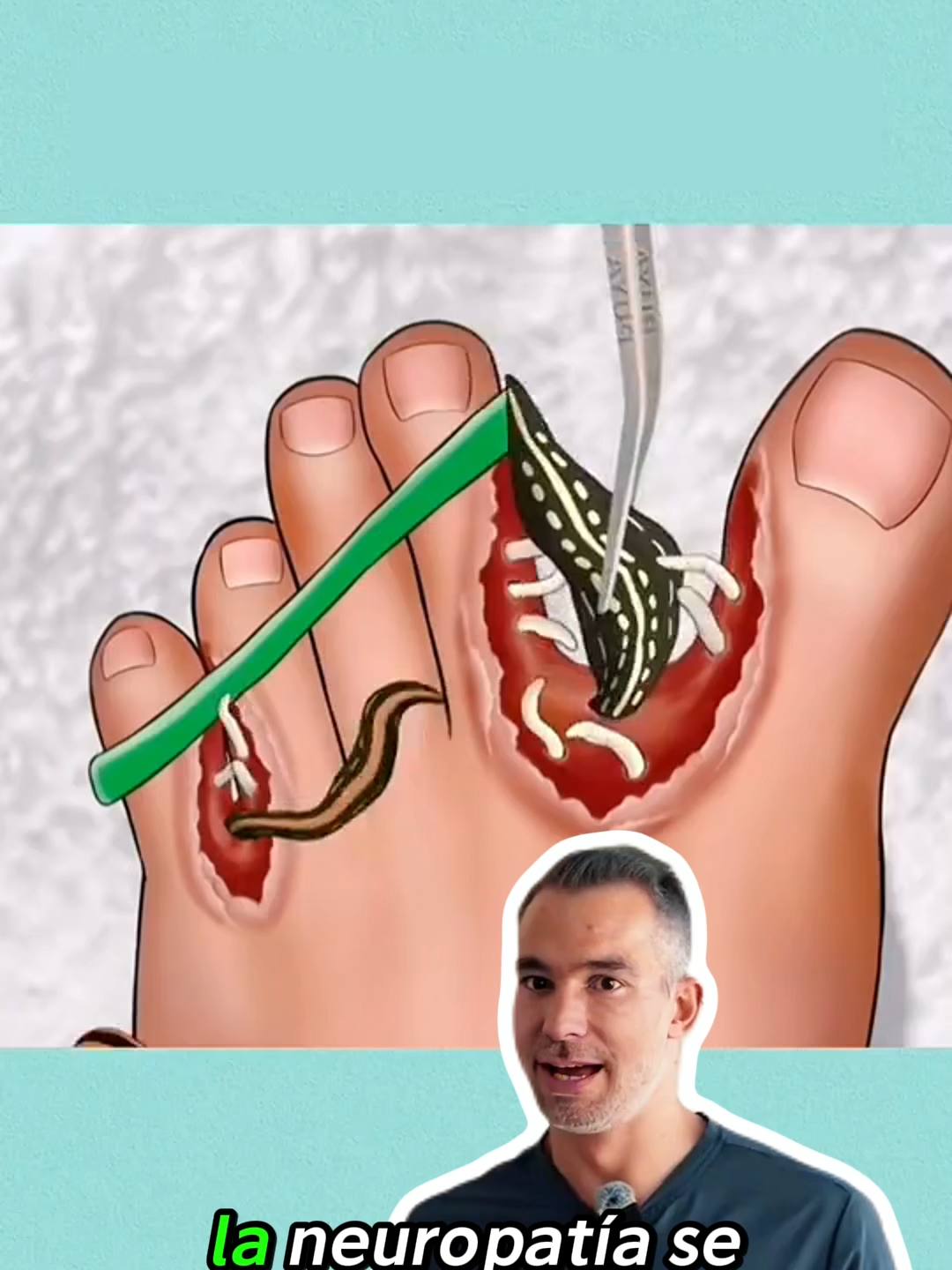 #neuropathy #neuropatia #migrastil #bienestar #salud #medicinanatural #doctor