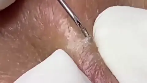 Góc của Din acne treatment 212 #acne #acnetreatment #usa 