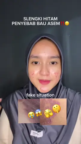 jangan cuma rawat muka, tapi slengkinya dirawat juga dongg!😭 #bekasluka #Ruam #CreamGatal #CreamIritasi #ciaraindonesia 