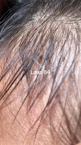 lice removal #omg😱😱 #lice #😱😱😱 #trending 