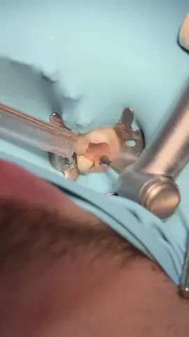 Deep tooth caries with root canal treatment #dentist #dental #dentistry 