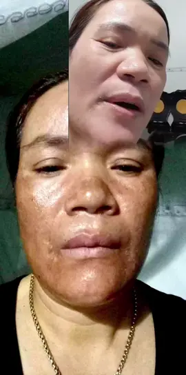 Xài hút sắc tố bênh út thì làn da đẹp hẳn #tinhchathutsactotangsau #sạm_nám_tàn_nhang #chamsocda #zalo  09/35/11/45/05#utthai 