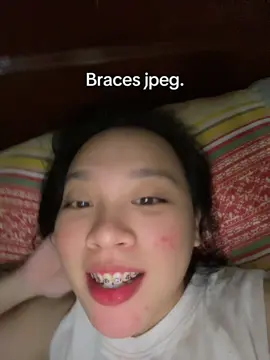 Ipatanggal ko nalang tong braces ko ante! Fb: Tine Acosta✨