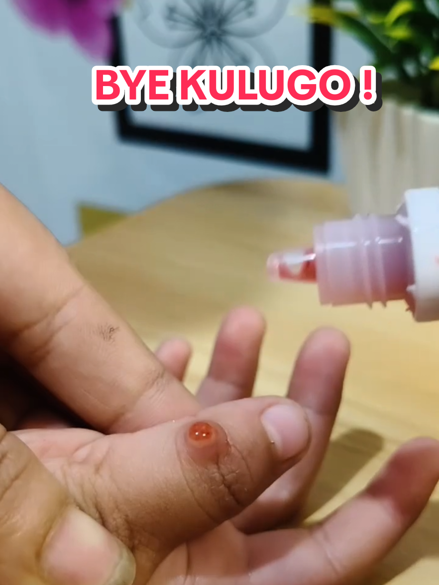 Replying to @delmaejanefuentebella  never na po bumalik KULUGO nya Mula nong napagaling nitong Nature's Miracle Warts Remover #wartsremover #kulugoremover #naturesmiraclewartsremoval #naturesmiracle 