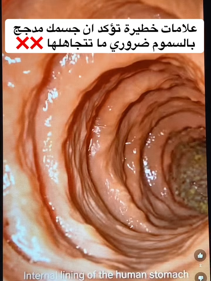 #قولون_معدة_غازات_إنتفاخات_إمساك_حموضة #إنتفاخ_البطن_والأمعاء #إنتفاخ_البطن #الرياض_جده_مكه_الدمام_المدينه #الرياض_الآن🇸🇦🇸🇦 #مكة_المكرمة_السعودية #السعودية_الكويت #توعية_صحية #الرياض_الان #خمول #الدمام #قولون_هضمي #إمساك_مزمن #إمساك #إنتفاخ_القولون