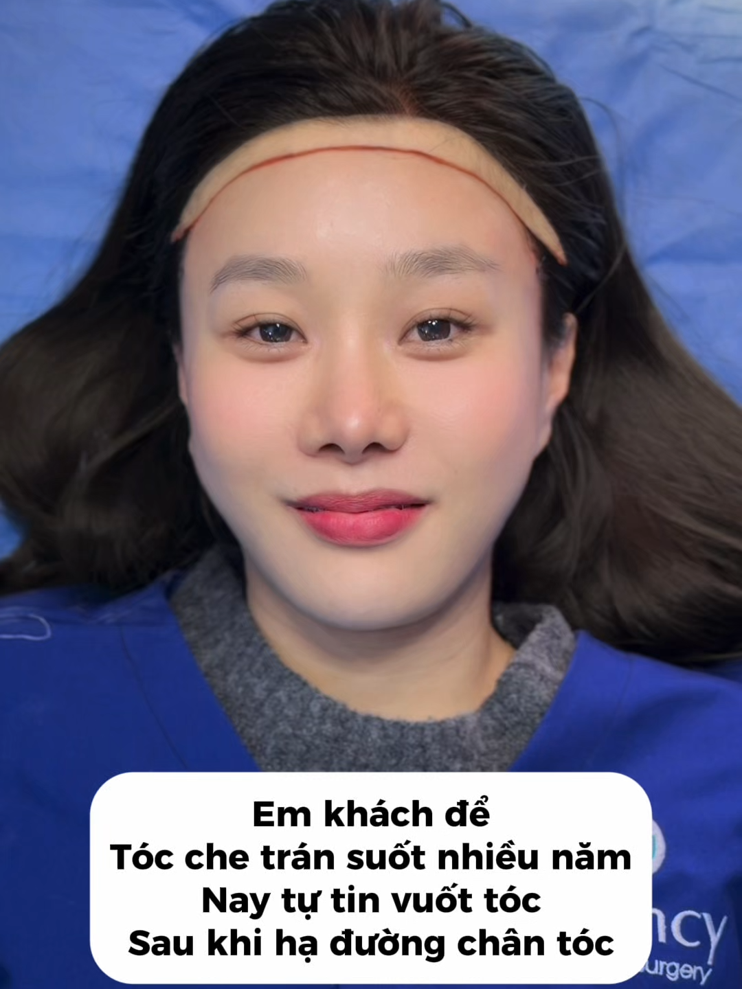 Từng rất tự ti vì trán cao và hói chữ M, tạo kiểu tóc nào cũng khó và không như ý muốn. Giờ thì tự tin hẳn sau khi hạ đường chân tóc, trán cân đối – trẻ trung hơn, nhìn đâu cũng thấy xinh 🩷 #hạ_đường_chân_tóc #haduongchantoc #viral #bichphuong
