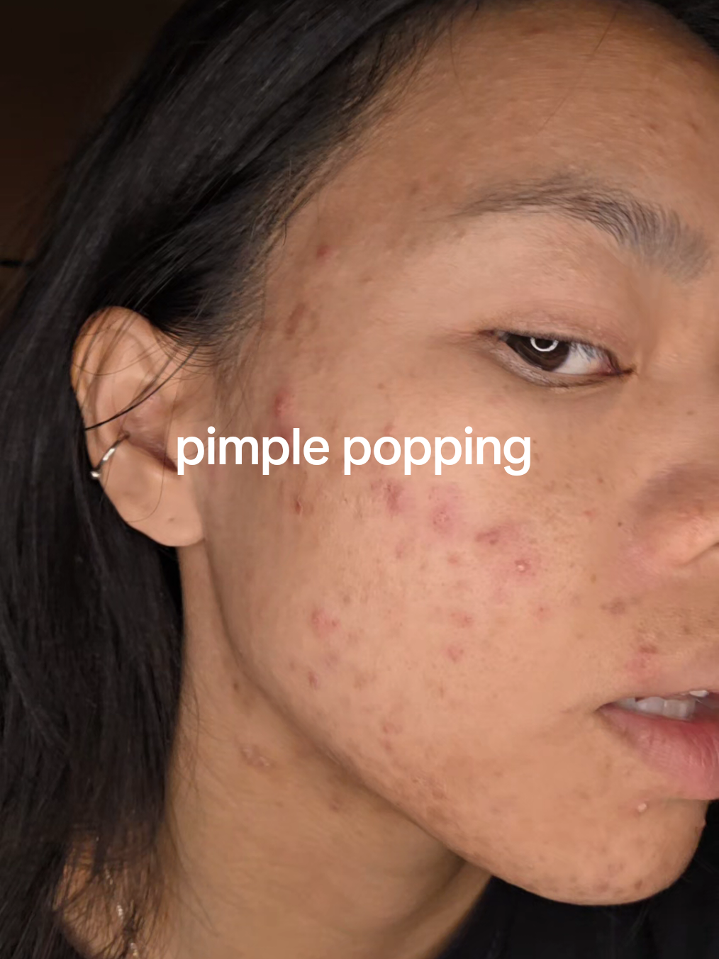 Pimple Popping part 10  ##pimplepopper #pimplepopping #extractions ##acne 