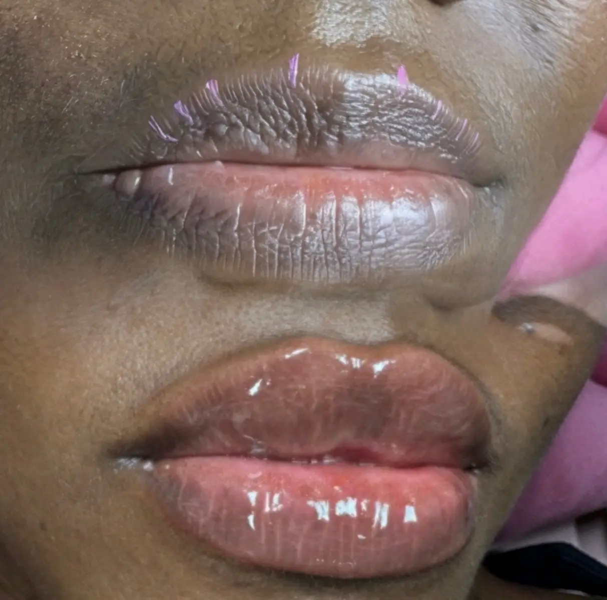 Ready to transform your smile? Book your consultation today and let’s create the perfect pout together!  📲 469-358-4738 📍 Midlothian (Near:Grand prairie,Arlington,Mansfield,Cedar Hill and surrounding Dallas area) 💌 DM me for questions or to schedule your appointment! #booknow️ #lipfiller #dallas #fyp #enhanceaesthetics 