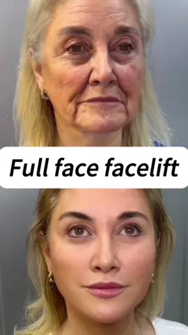 #facelift #Antiaging #FacialAesthetics #getbetter #Younger 