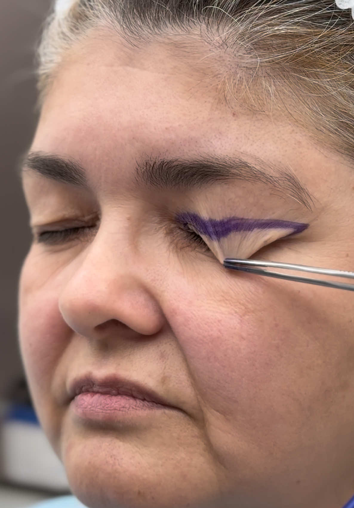 O noua schimbare spectaculoasă  #drlevymedicalcenter #plasticsurgeonsoftiktok #blefaroplastica #blefaro 