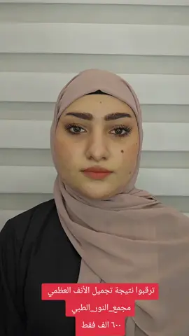 #تجميل_الأنف #دكتورة_نور_امين #مجمع_النور_الطبي 