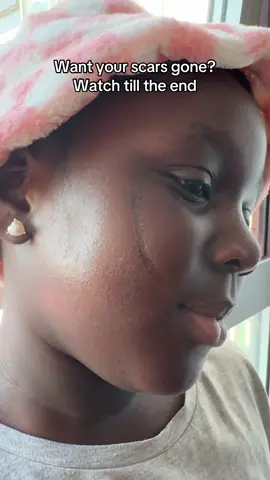 Remove your old and new scars and also stretchmarks #stretchmars #fyp #scar #scargel   