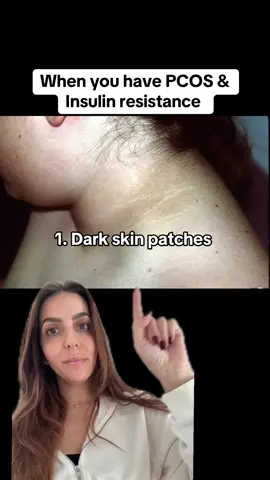 Do you have any of these PCOS symptoms? Extreme cravings, dark skin patches, and skin tags are just some of the ways insulin resistance manifests in our body! #pcos #pcoslife #pcosweightloss #pcosproblems #pcosawareness 