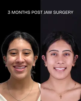 Major jaw and airway improvement using Custom Orthognathic Surgery. An amazing result for an amazing person ™