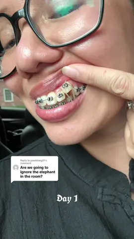 Replying to @pawldawg01 We can finally stop ignoring the elephant!  The wire is basically straight! ✨ I’m so lazy to continue but we did it yall! 45 days after the bracket was put on the canine HAHA woohoo!  @Yanni Family Ortho #braces #adultbraces #snaggletooth #bracescheck #bracesjourney 