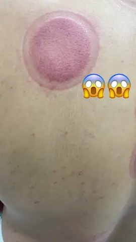 اثآر الحجامة العشوائية تدوم لعدة سنوات#حجامة_بسكرة #الجزائر🇩🇿 