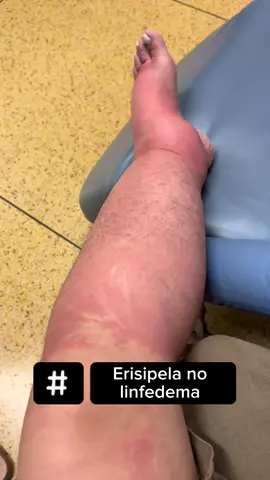 A erisipela é uma infecção séria que pode surgir de algo simples — uma picadinha de mosquito, uma micose entre os dedos, uma feridinha pequena… Pra quem tem linfedema, isso acontece porque o sistema linfático tem mais dificuldade de se defender contra bactérias. 🚨 Por isso, se a pele ficar vermelha, quente, dolorida ou com febre, procure um médico imediatamente! Cada episódio pode agravar o linfedema e atrasar o tratamento. 💧 A prevenção é o nosso maior escudo: hidratar a pele todos os dias, cuidar das unhas, evitar andar descalça e tratar qualquer machucado logo no início. Cuidar da pele é cuidar do seu linfedema, da sua saúde e da sua história. 💚 #LinfoFly #Linfedema #Erisipela #CuidadosComAPele #Autocuidado  
