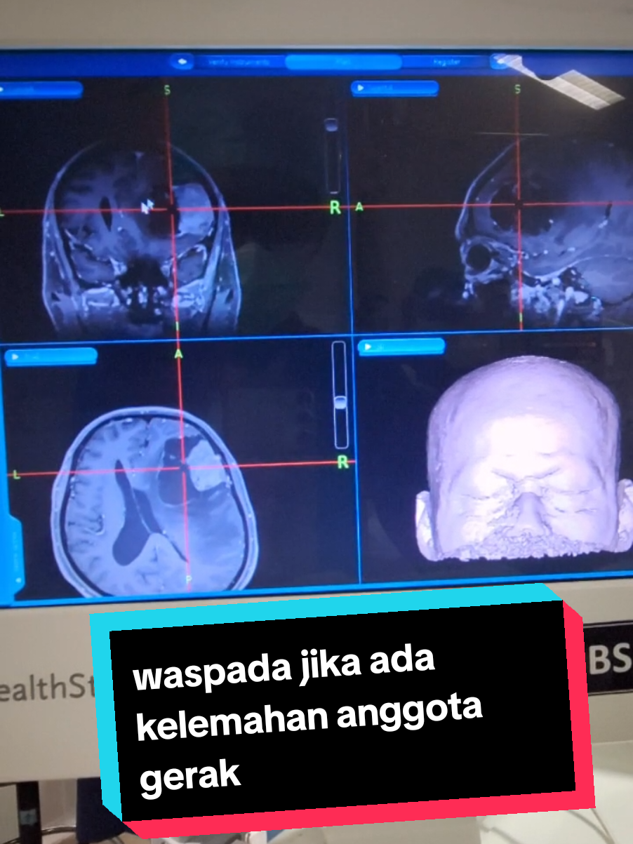 Berikut adalah rekonstruksi 3D Tumor pada MRI menggunakan alat neuronavigasi. salah satu gejala pada tumor otak ini adalah kelemahan anggota gerak tubuh (tangan dan kaki) sebelah kiri. maka kita perlu waspada jika ada gejala tersebut by: Janu Isworo #tumorotak #braintumor #fyp #januisworo #MRI 