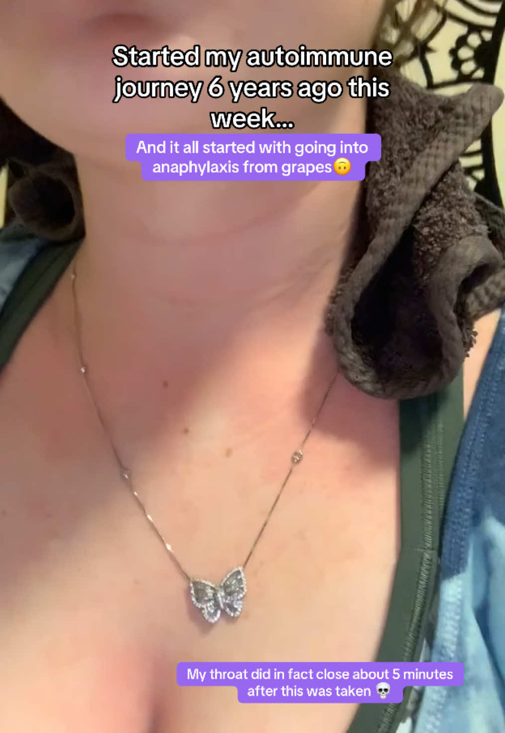 Never thought I’d let this one out of the vault but Happy 6 Years being chronically ill🥳  #lupuswarrior #autoimmunedisease #anaphylaxis #foodallergy #hives 