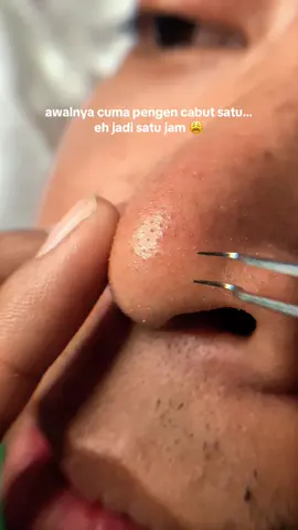 kenapa ya cabut komedo tuh satisfying bgt😭  #cabutkomedo #komedo #pinsetkomedo #pinset #fyp 