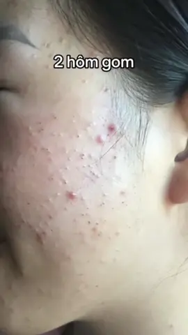 #gomcoimunsau3den10ngay 