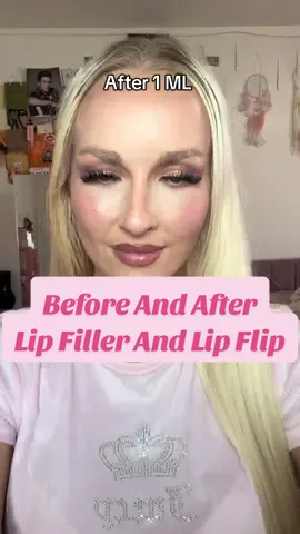 Best decision ever! I think 3MLs of Lip Filler would be and sweet spot but I’m so happy with 2.75 MLs and a Lip Flip. I had such small lips before and my top lip would curl up when I smile. Chefs kiss 💋 to that lip flip! I’ll keep you updated on results as they settle. #lipfiller #lipflip #fillerbeforeandafter #lipfillerresults #lipflipresult 