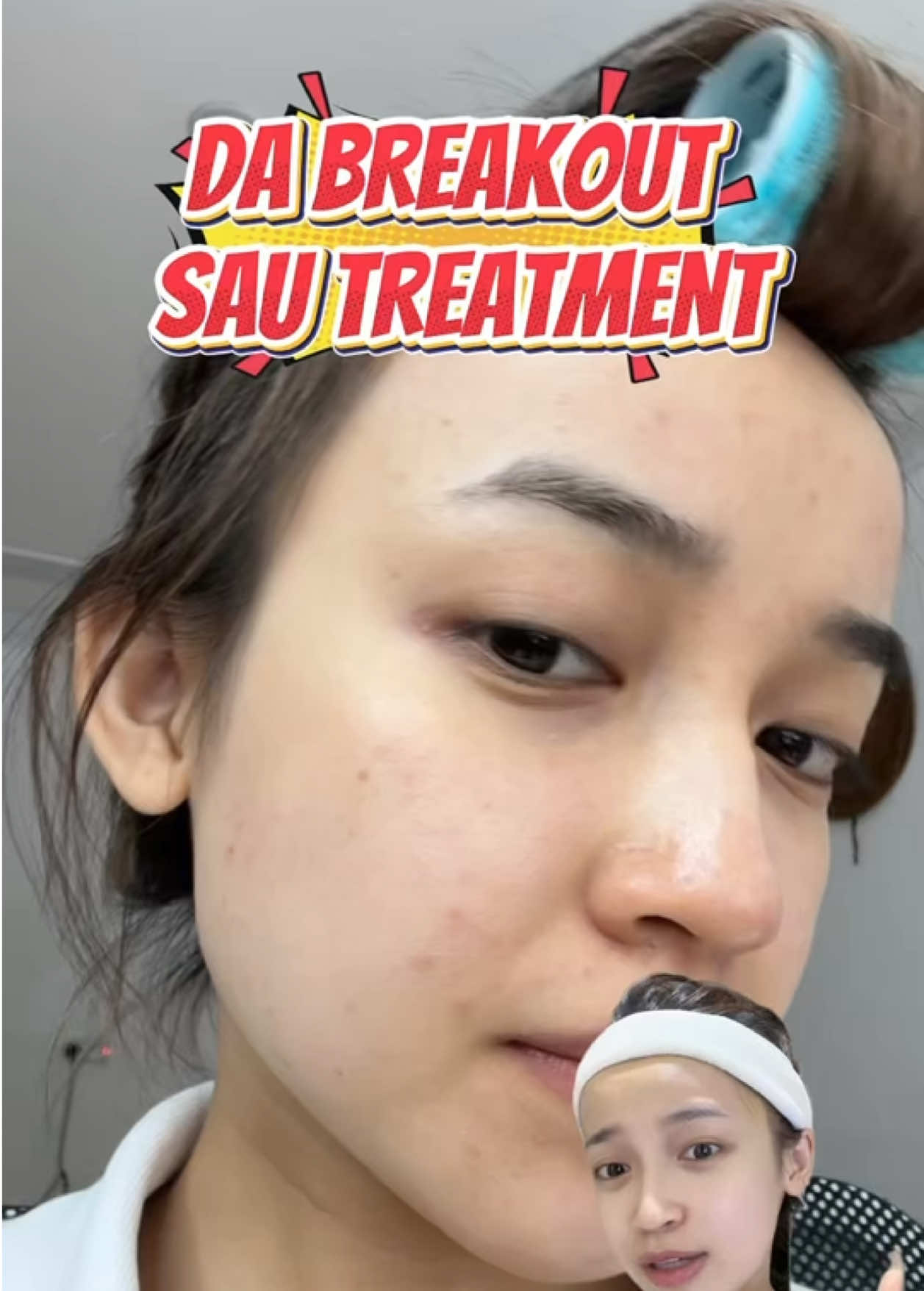 Da breakout sau treatment thì phải làm gì? #reviewlamdep   #VitaminB5Timeless #Timeless #SerumPhucHoi #SerumB5