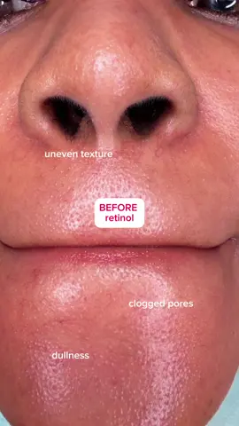 Retinol was the turning point for my skin - once I started, everything changed. It’s made a difference to my texture, skin tone and just general skin health. It’s scary to start but this retinol serum from @Dr.Althea US is great for beginners! Calm, hydrating, and beginner-safe but still powerful. #kbeauty #dralthea #retinol #sensitiveskin #glassskin 