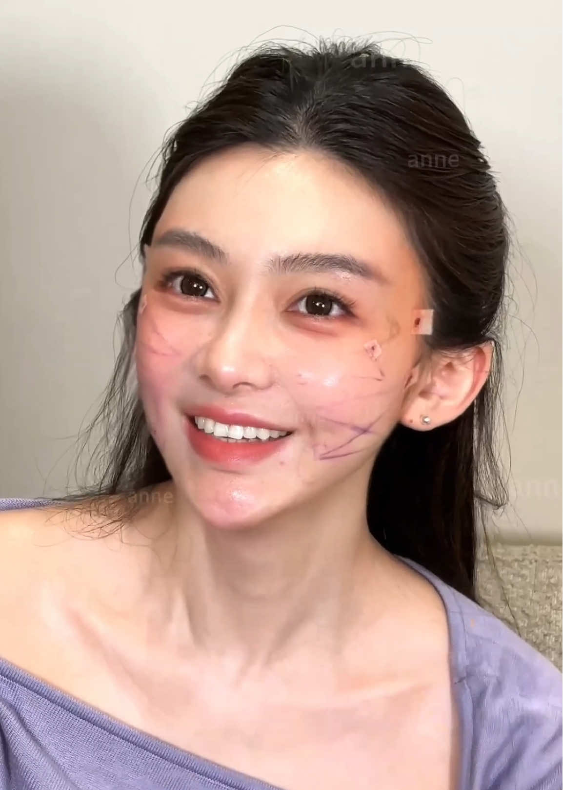 As a doctor, the greatest satisfaction comes from seeing my patients look in the mirror after their 9D Facelift — and truly fall in love with their reflection again. ✨ #9DFacelift #FacialLift #DoctorPerspective #FacialRejuvenation #NaturalBeauty     