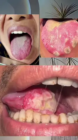 #bacteria #acidreflux #fungus #tanzaniantiktok🇹🇿 #candida 