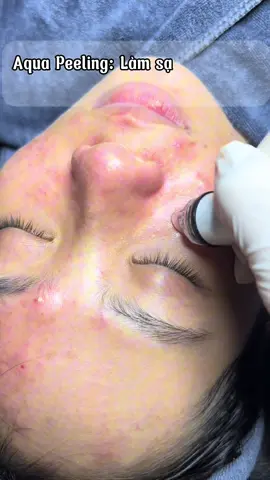 Aqua Peel: Sạch sâu từng LCL sau 15p chạy máy 🥰#khuongle #kbeautyspa #xuhuong2025 