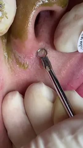 Cục to #chamsocdamun#chamsocdanam#chamsocdaseo#lequynhspa#hocnghespa 