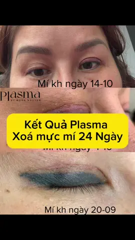 Kết quả Plasma xoá Mí 24 ngày #Plasma #plasmaxóamí #Plasmamày #plasmamôi #PMU @Moon Nguyen 🏳️‍🌈 @Maily Phun Môi Trong Veo 