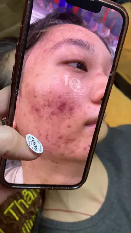 Cập nhật da mụn #chamsocdaseo#chamsocda#chamsocdamun#chamsocdanam#tanbinh        