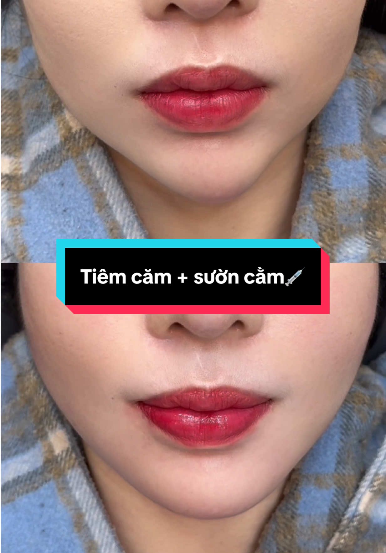 FIX CẰM LỖI  Khách từng tiêm filler cằm ở nơi khác bị hõm, nhọn và chảy xệ mất form. Được Tiên tái tạo lại dáng cằm, bổ sung viền cằm – góc mặt, giúp khuôn mặt cân đối, thanh tú và sắc nét chuẩn tỉ lệ  💉#xuhuongthammy #rachgia #cantho 