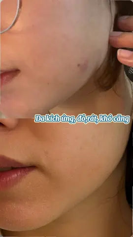 Da mình yếu, khô, mẩn đỏ chứ không yếu lòng 😭 May có Cicaplast B5+ xoa dịu sau những ca trực 💙#Cicaplast #HợpTácCùngLarocheposay #chamsocda 