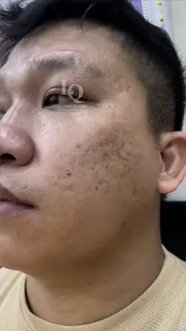Cập Nhật da sẹo#lấynhanmunbangtay#chamsocdamun#chamsocdaseo#chamsocdanam#tanbinh    &Acedemy