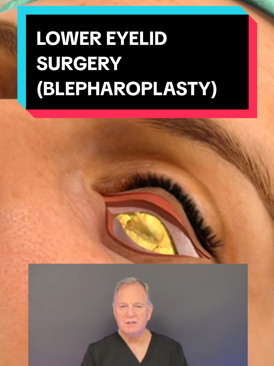 lower lid blepharoplasty @Dr. Mark Schusterman, MD, FACS #blepharoplasty #lowereyelidsurgery #cosmeticprocedures #plasticsurgery #miami 
