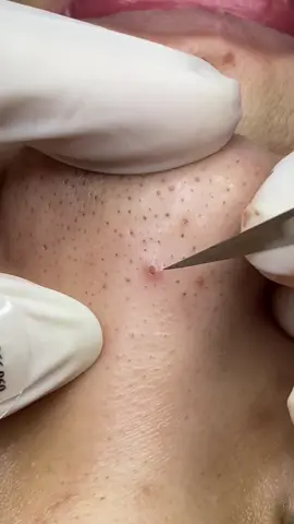 Perennial on the nose #spa #beautify #squeezingpimples #skincare #asmr 