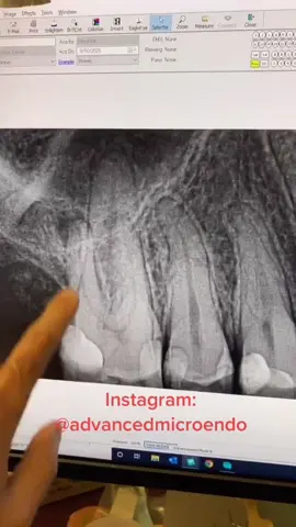 #dentists #dentalstudent #dentalhygienist #rootcanal #dentalofficelife 