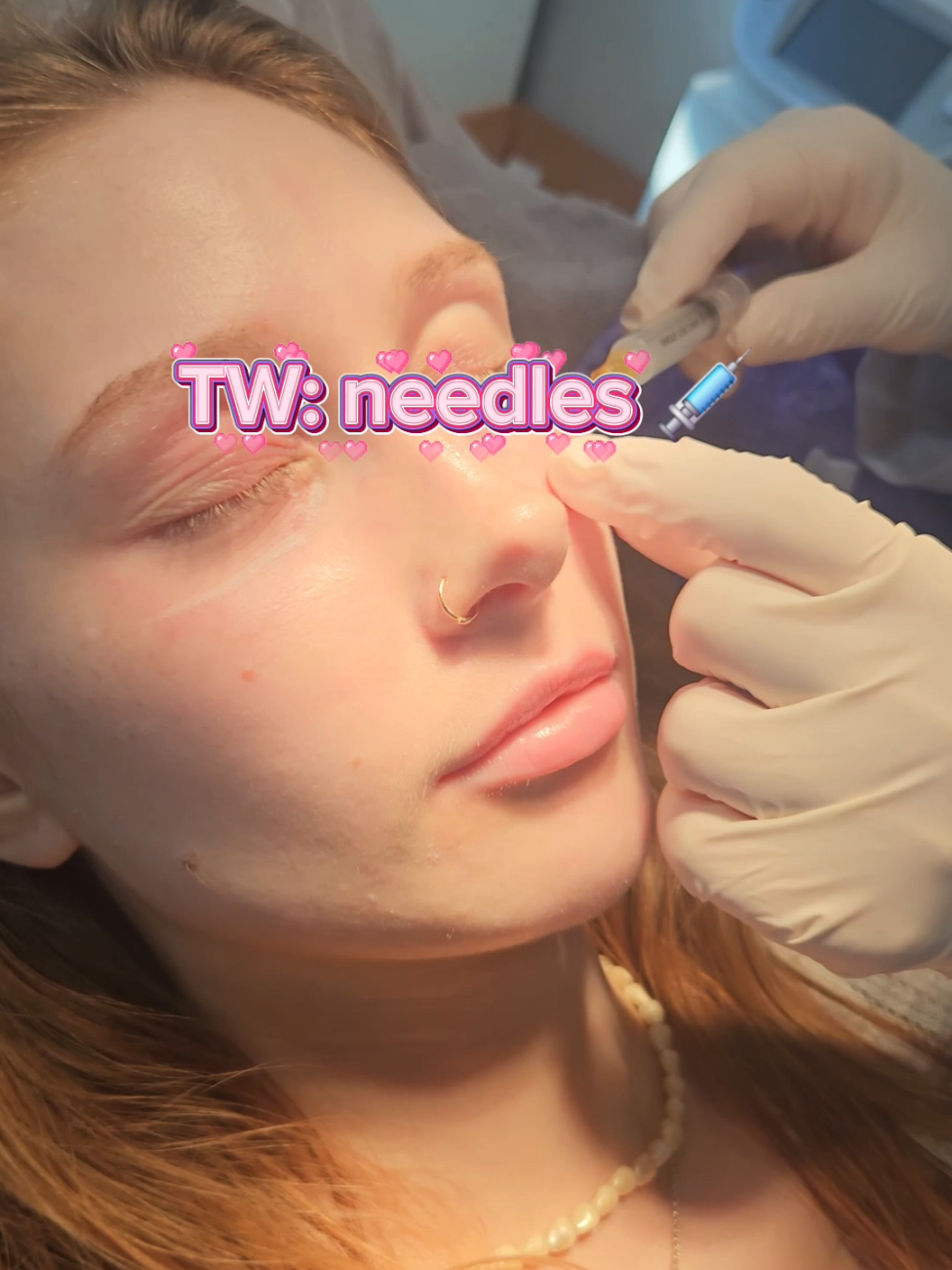 Honestly LOVED this clinic and their approach to skincare, they even reviewed how my undereyes were healing and advised waiting before doing it again for BEST results 🥹💗 super happy with my visit here and will 100% be going back 🤭  📍Dami Clinic 44-37 Yeouido-dong Yeongdeungpo-gu Seoul https://naver.me/xPpX6TtW  #skincare #kbeauty #skincareclinic #juvelook #korea 