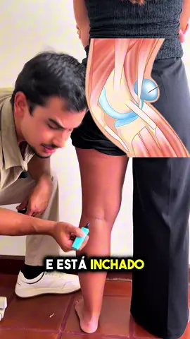Dor na parte de trás do joelho  Quando sentes dor ou inchaço atrás do joelho, o problema pode vir de várias estruturas. Se notas a zona posterior inchada, principalmente no centro da fossa, pode tratar-se de um quisto de Baker — basicamente, uma bolsa de líquido que se forma quando há excesso de pressão dentro da articulação. Normalmente aparece associado a artrose, inflamação ou lesões meniscais. Agora, se a dor é mais interna, aqui junto ao gémeo interno, o mais provável é ser uma sobrecarga ou pequena lesão muscular. É típico de quem fez um sprint, um salto, ou um movimento explosivo de flexão plantar — como correr em subida ou arrancar rápido. Nesses casos, dói mais quando estendes o joelho ou ficas na ponta dos pés, e pode até dar uma sensação de “picada” ou “rutura”. Já o poplíteo, que não falámos no vídeo, é um músculo mais profundo. A dor costuma ser mais central ou ligeiramente lateral atrás do joelho, e piora quando desces escadas, travas uma descida ou fazes rotação interna do joelho. Portanto: 👉 Inchaço central — pensa em quisto de Baker. 👉 Dor medial — mais provável gémeo interno. 👉 Dor profunda ou lateral — pode ser poplíteo. Segue-me para aprenderes a tratar as tuas dores  #fisioterapia #osteopatia #gemeo #joelho #tendinite 