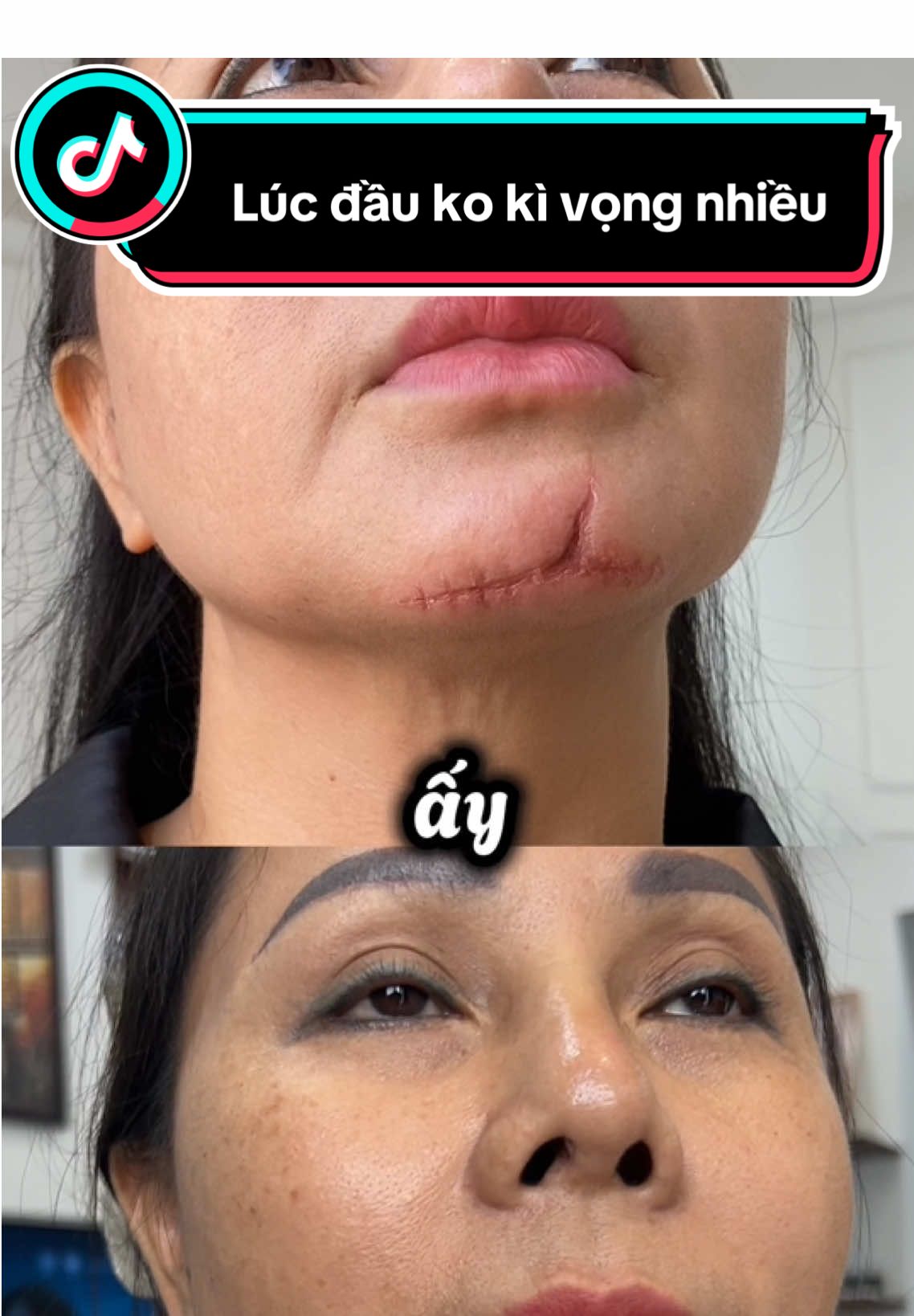 Lúc đầu không hi vọng gì nhiều nhưng đã phải bất ngờ vì Actiscar #actiscar #kemmoseo #seolom 