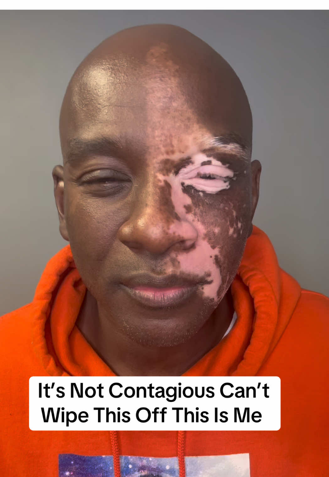 Vitiligo doesn’t need a cure it need understanding 