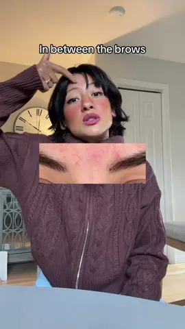 Every pimple (acne) is a breadcrumb booboo #acneproneskin #acnetips #acnescars #holistichealing 