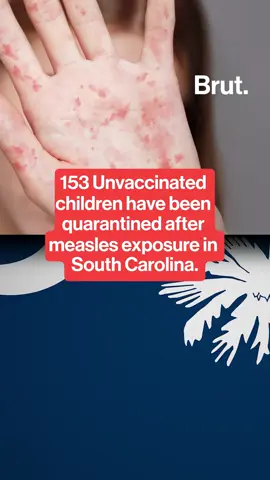 153 unvaccinated students have been quarantined in Spartanburg County, South Carolina, after confirmed measles exposure at two schools. Health officials report 11 total cases in the state, warning of the virus’s rapid spread in unvaccinated communities and urging vaccination to prevent further transmission. #MeaslesOutbreak #SouthCarolina #PublicHealth