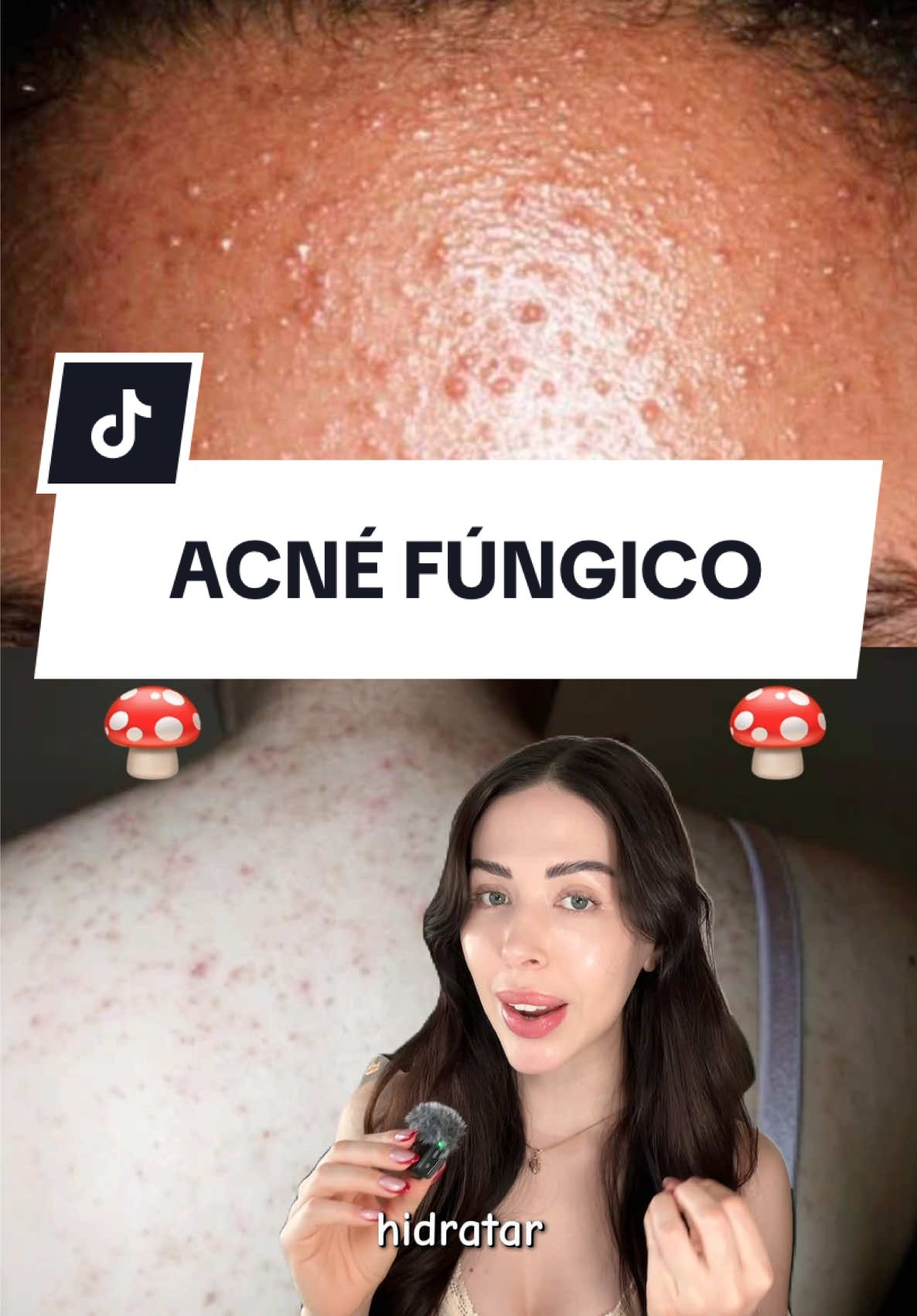 ✨NO TENGAS MIEDO, HIDRATAR TAMBIÉN ES TRATAR LA PIEL💧 Muchas veces pensamos que la hidratación empeora el acné… pero en realidad puede ser justo lo que tu piel necesita después de tantos activos fuertes🫧✨ Te enseño cómo elegir una crema que calme, repare tu barrera y no alimente el hongo Malassezia 🍄 #acneskincare #malassezia #skincaretiktok #skincarecoreano       #creatorsearchinsights @YesStyle @YesStyleInfluencers @dr.althea_es @Dr.Althea US 